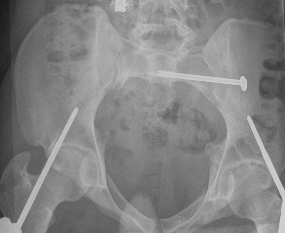 Pelvis Sacroiliac Screws Inlet